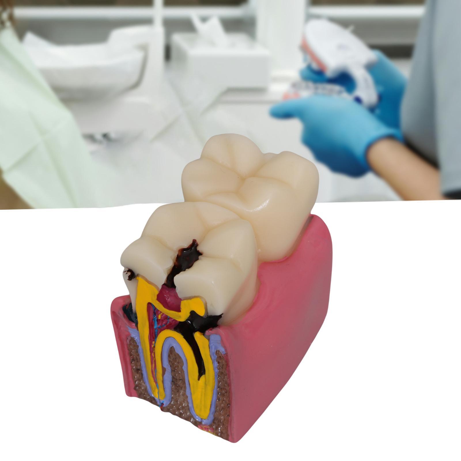 Kids Education Classes - Modello di carie per denti Radici