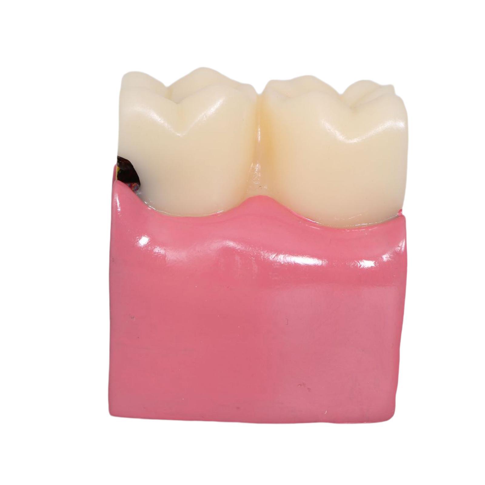 Modello di carie per denti Rad - Kids Education Classes recensione e prezzo