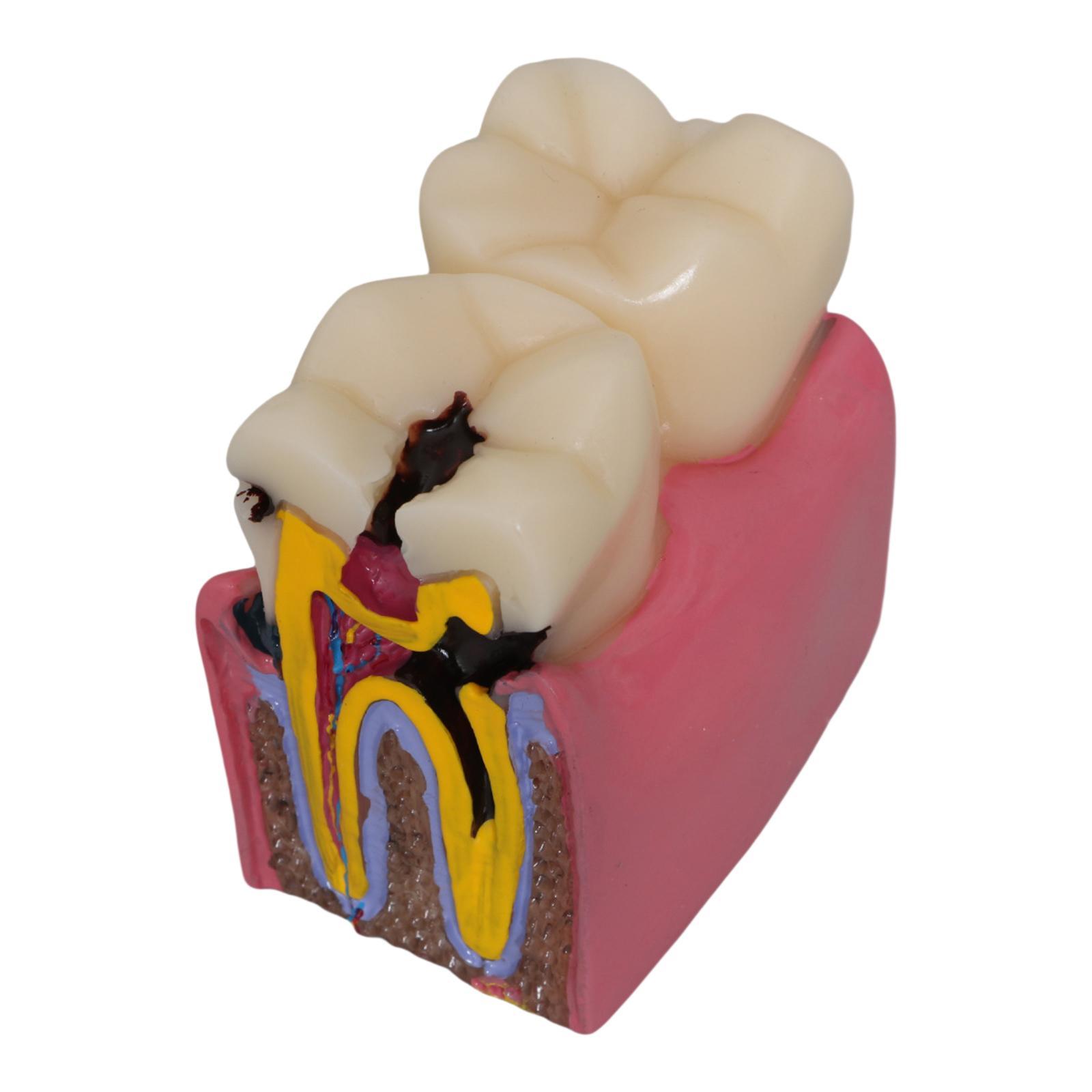 Modello di carie per denti Rad - Kids Education Classes recensione e prezzo